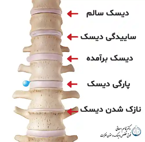 درمان دیسک کمر  و راه های درمان