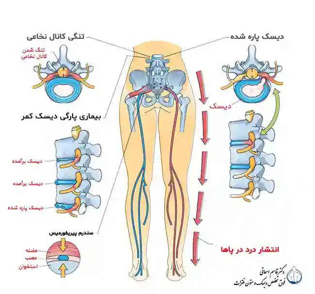 علائم دیسک کمر در پاها