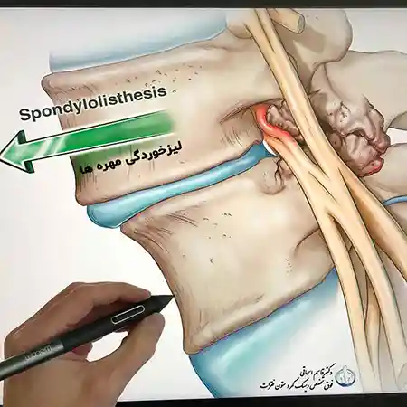 لیزخوردگی مهره کمر