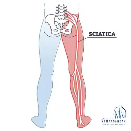 عصب سیاتک و روش های درمان عصب سیاتیک
