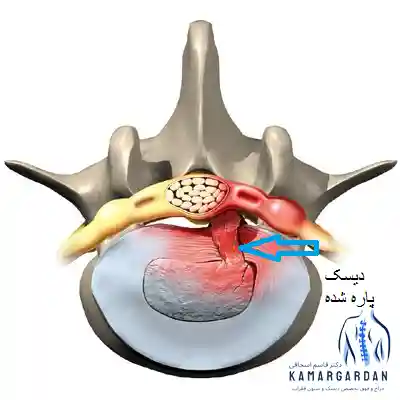 جدیدترین روش های پارگی دیسک کمر