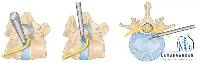 جراحی آندوسکوپی دیسک کمر