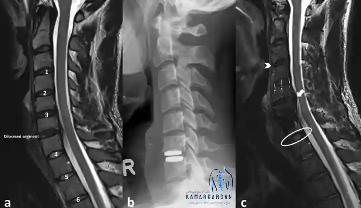 تصویربرداری ام آر آی دیسک گردن