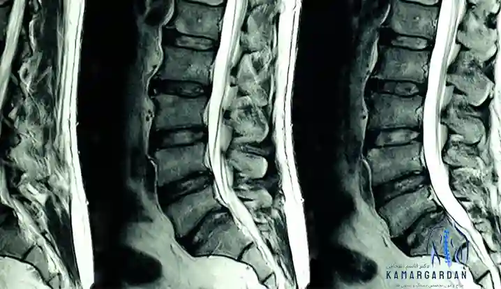 تصویربرداری ام آر آی دیسک کمر