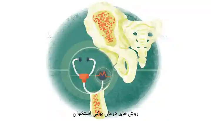 روش های درمان پوکی استخوان