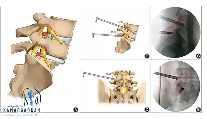 جراحی سرخوردگی مهره کمر