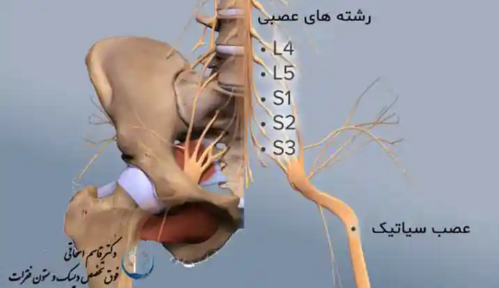 رگ سیاتیک کمر چیست ؟