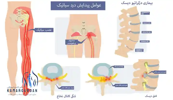 چه عواملی باعث پیدایش درد سیاتیکی می شوند؟