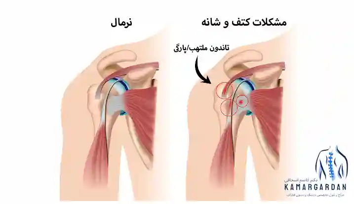 علت درد کتف و شانه چپ و روش های درمان