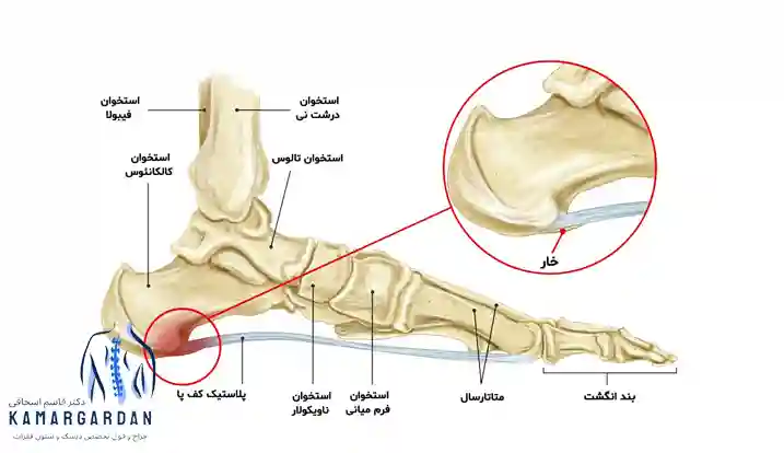 خار پاشنه علائم و راه های درمان خار پاشنه