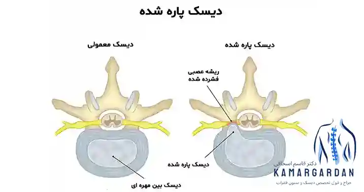 پارگی دیسک گردن و روش های نوین درمان