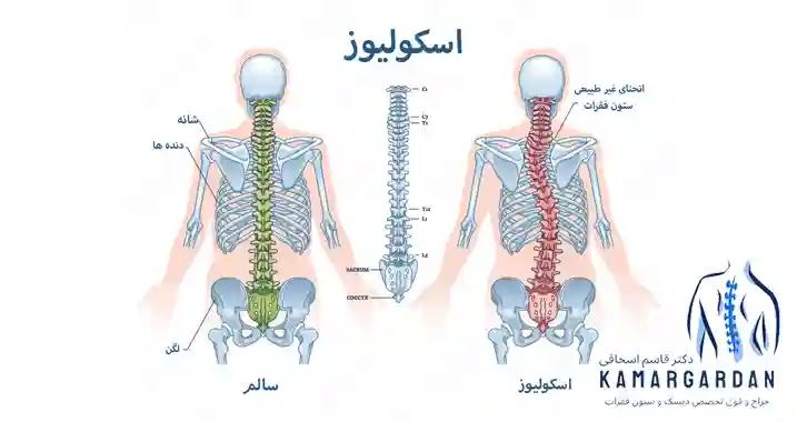 ورزش های اسکولیوز