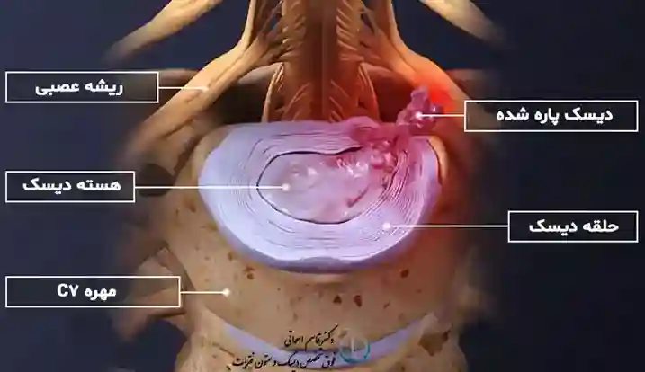 روش های نوین درمان دیسک گردن