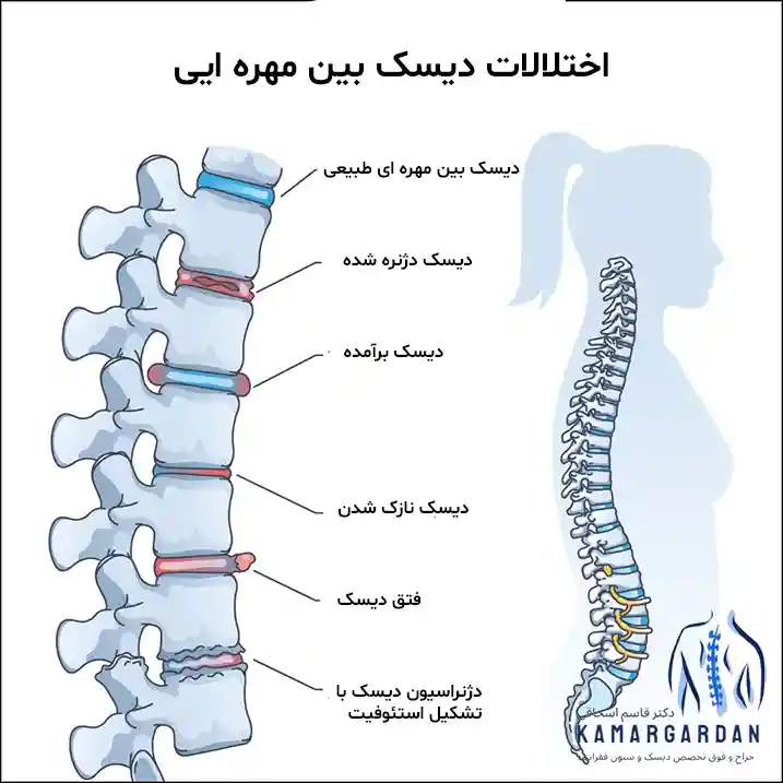 اختلالات دیسک بین مهره ای