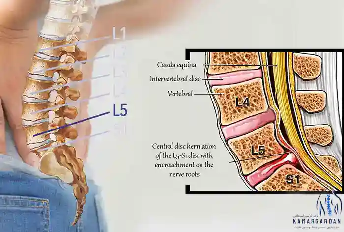 جراحی دیسک L5 S1 : راهکاری برای کاهش درد و بهبود کیفیت زندگی