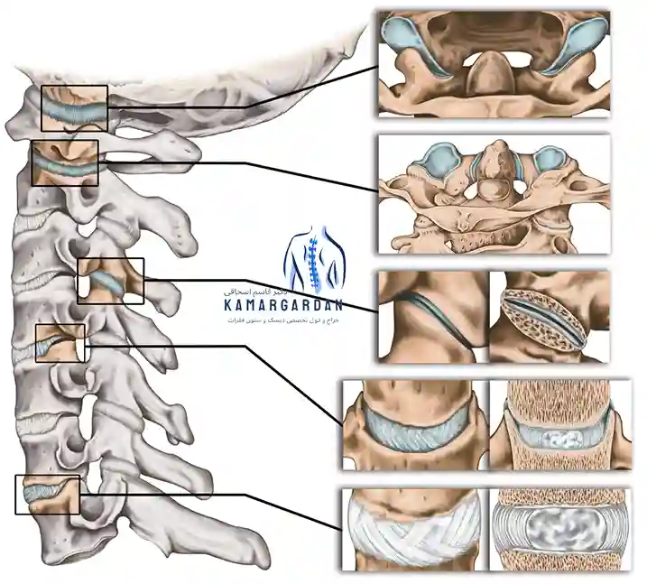 تغییرات تنه مهره پس از بیماری دیسک