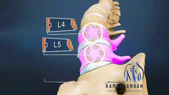 درمان دیسک کمری مهره 4 و 5