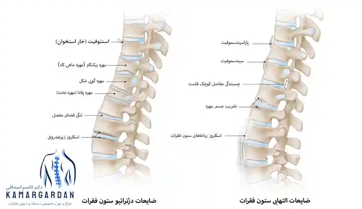 انواع بیماری دیسک کمر