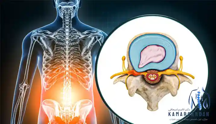 فتق دیسک کمر و روش‌های درمان بیرون زدگی دیسک کمر