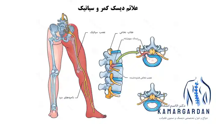 علائم دیسک کمر و سیاتیک: آشنایی با نشانه‌ها و راه‌های درمان