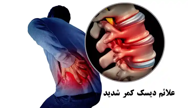 علائم دیسک کمر شدید: آنچه باید بدانید