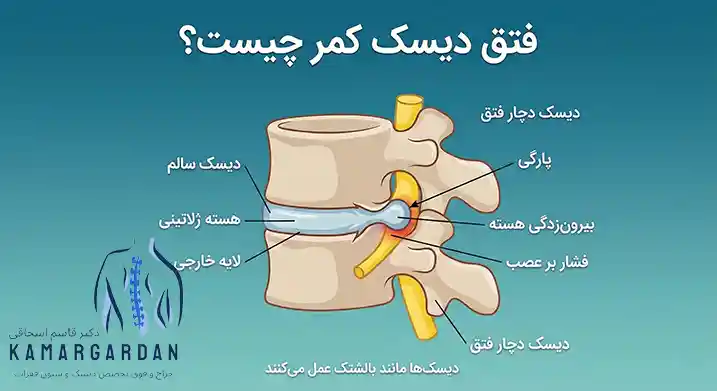 فتق دیسک کمر چیست؟