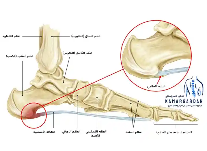 مهماز الكعب، أعراضه وطرق علاجه