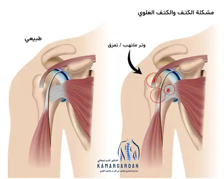 سبب آلام الكتف الأيسر والكتف وطرق العلاج