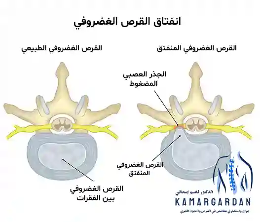 تمزق القرص العنقي وطرق العلاج الجديدة