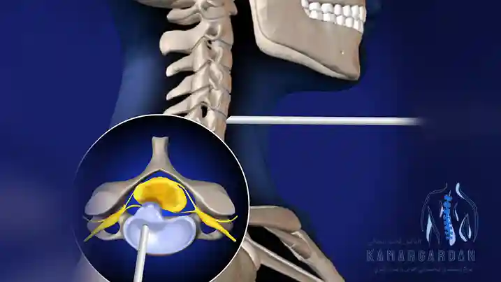 علاج وجراحة القرص العنقي بالليزر