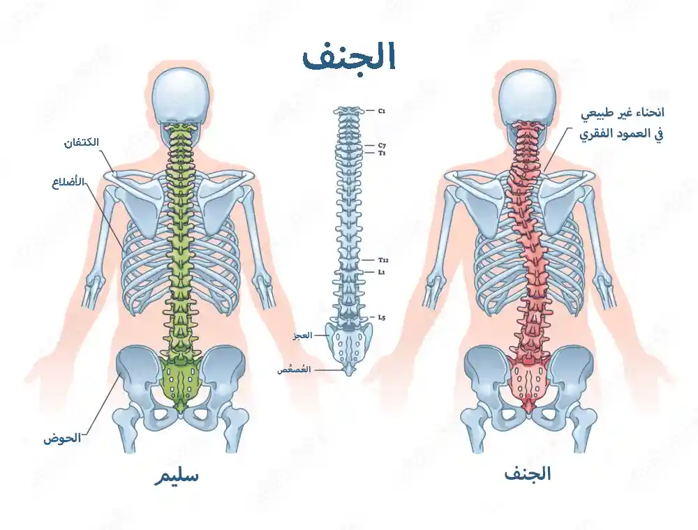 تمارين الجنف