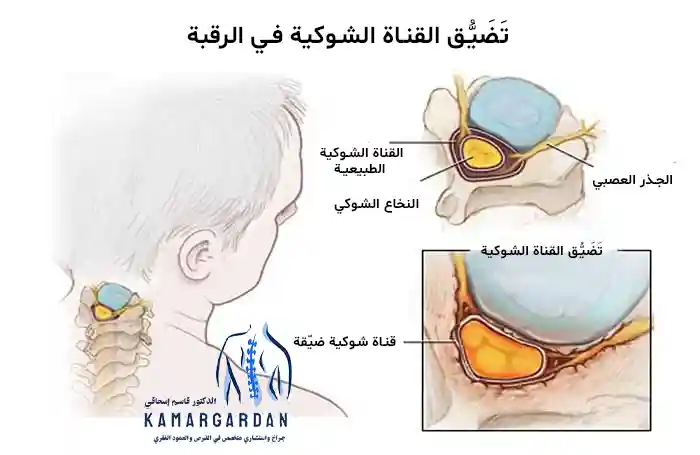 تضيق القناة الشوكية العنقية