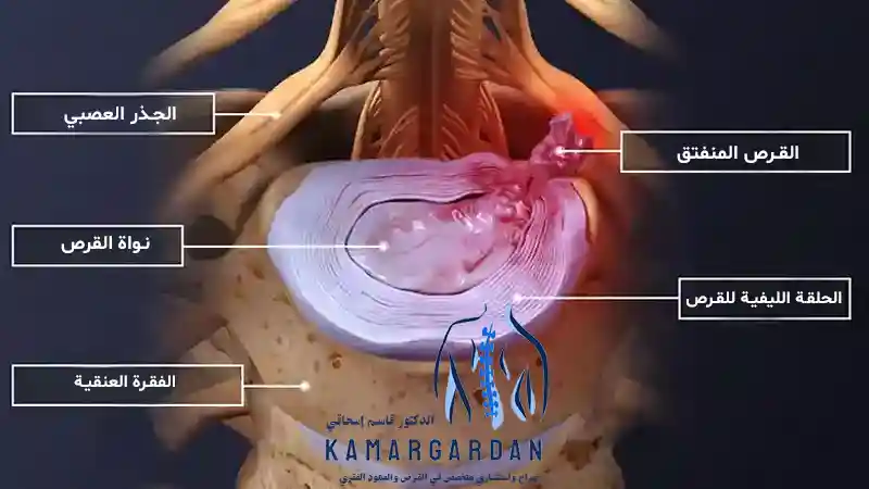 طرق جديدة لعلاج القرص العنقي