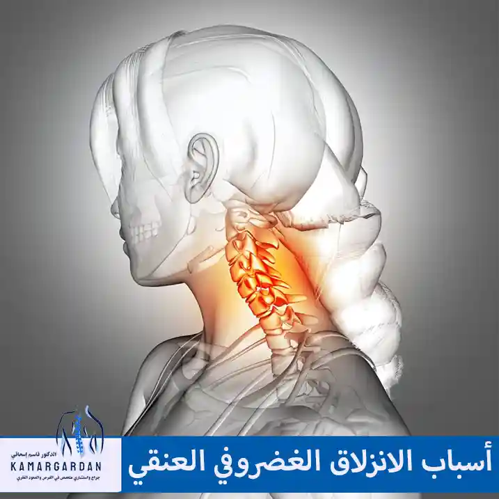أسباب الانزلاق الغضروفي العنقي وكيفية معرفة ما إذا كنا نعاني من القرص العنقي؟
