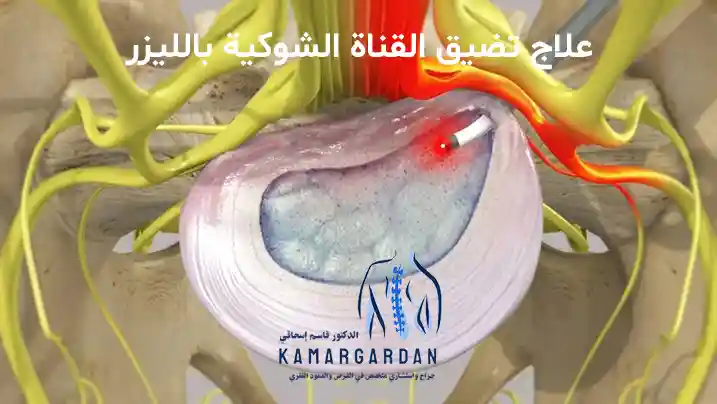 علاج تضيق القناة الشوكية بالليزر