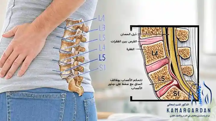 جراحة القرص L5 S1: حل لتقليل الألم وتحسين نوعية الحياة