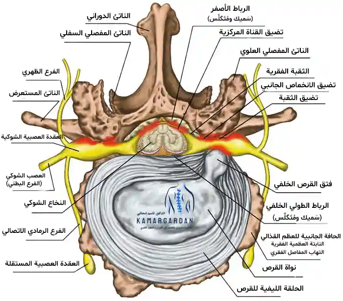 ضيق القناة الشوكية وطرق علاجه