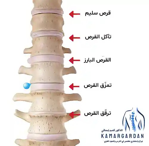 معالجة القرص القطني
