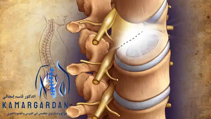 جراحة القرص القطني باستخدام الليزر