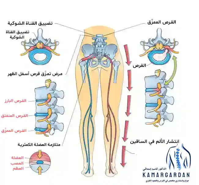 أعراض القرص القطني في الساقين: التعرف عليها وعلاجها