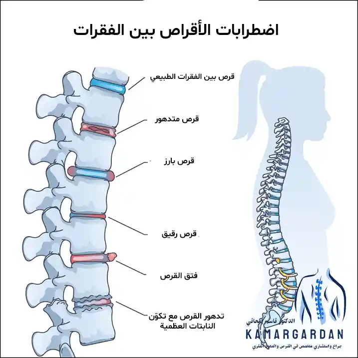 اضطرابات القرص الفقرية
