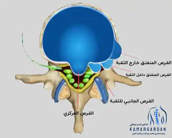 أنواع القرص القطني من حيث موقع التمزق