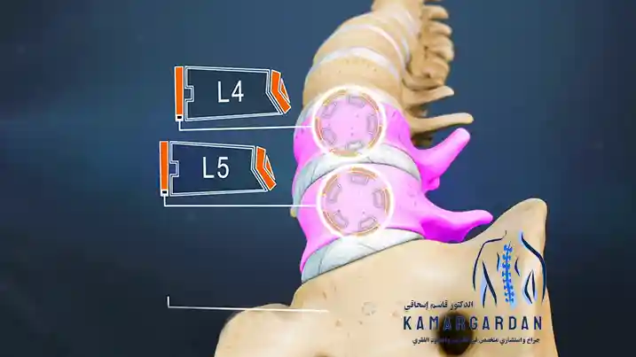 علاج القرص القطني للفقرة الرابعة والخامسة