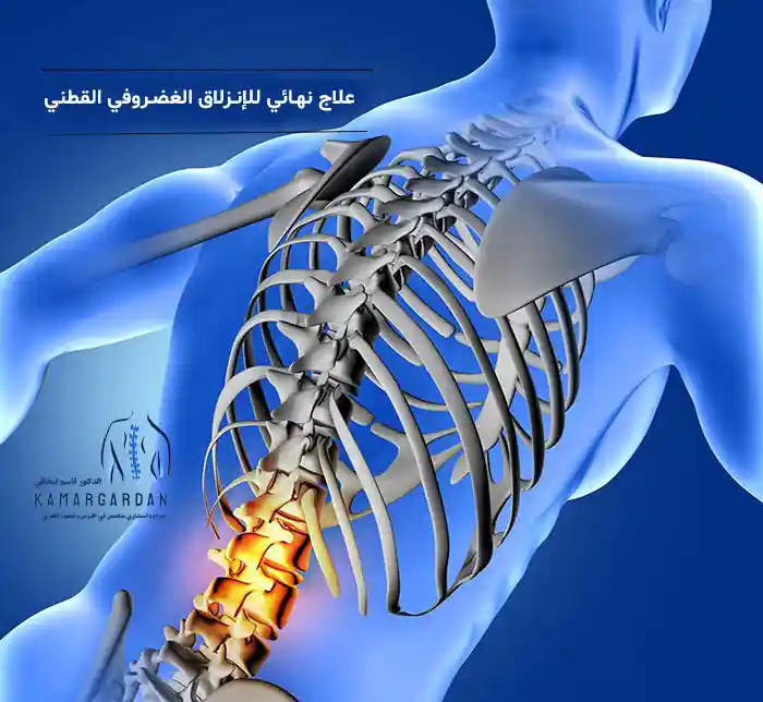 هل يوجد علاج نهائي للإنزلاق الغضروفي القطني؟