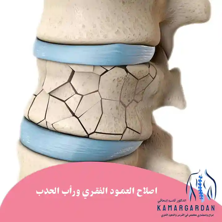 اصلاح العمود الفقري ورأب الحدب