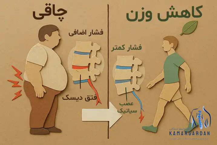 چاقی و سیاتیک