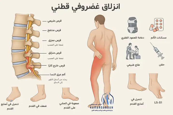 ما هي أعراض الانزلاق الغضروفي القطني والطرق الجديدة لعلاجه؟