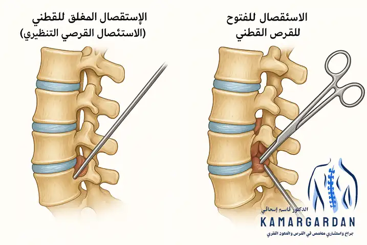 جراحة القرص الفقري
