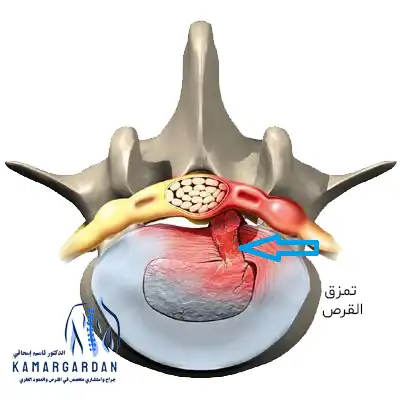تمزق القرص القطني