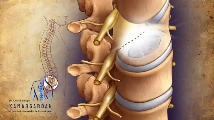 Laser Disc Surgery for the Spine